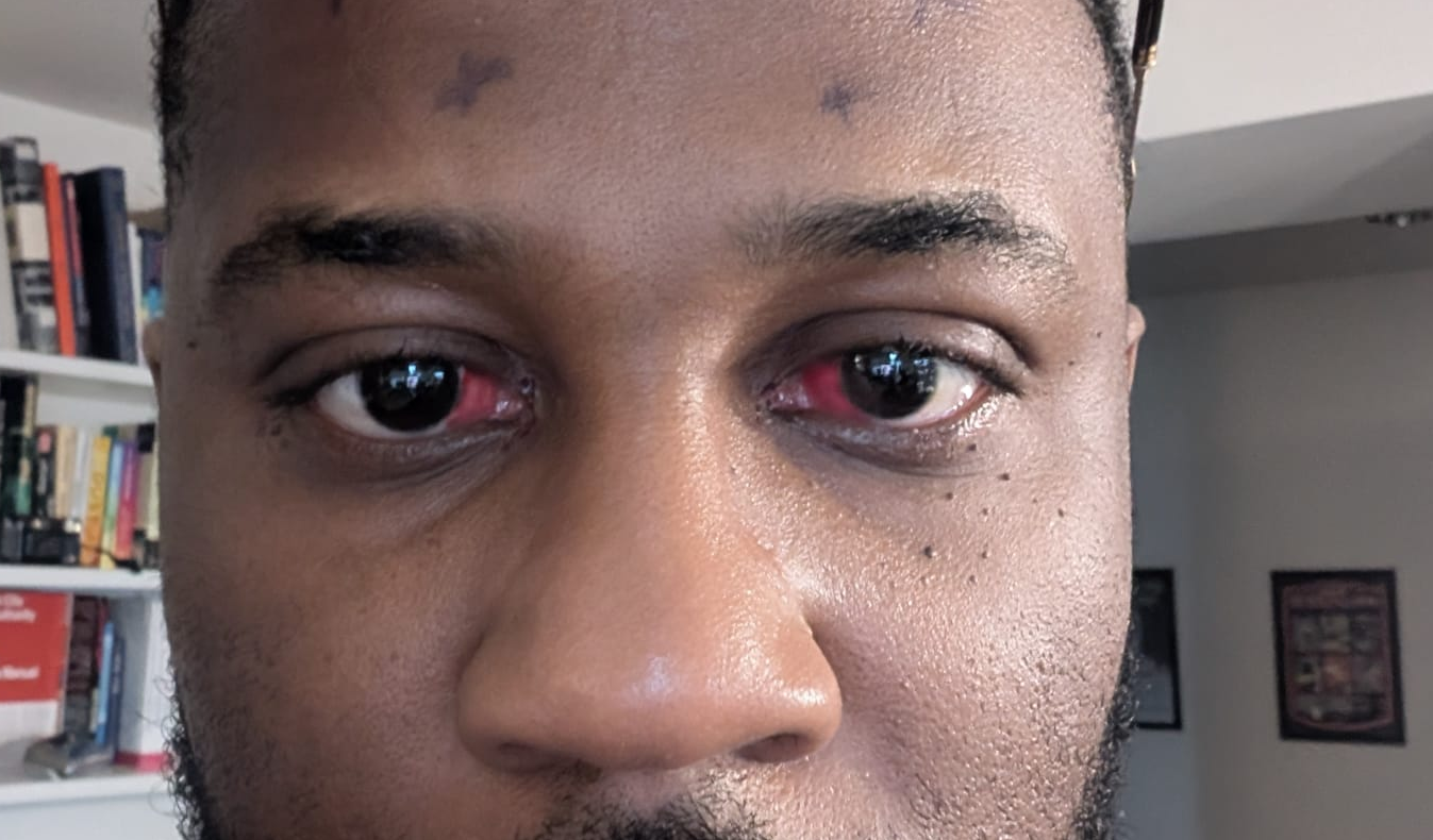 Photo of eyes after surgery