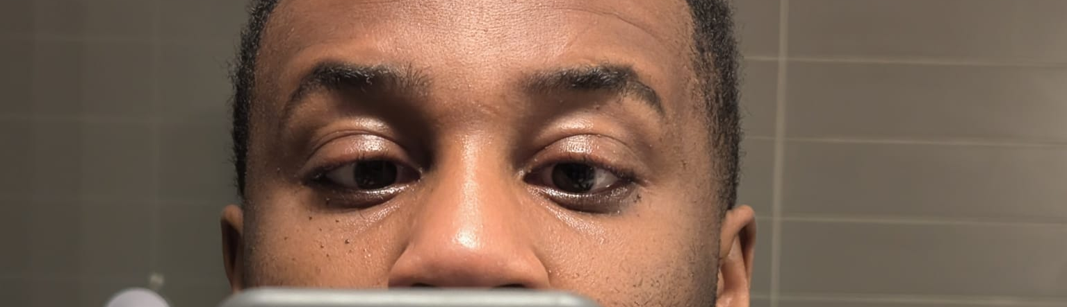 Photo of eye turning inwards